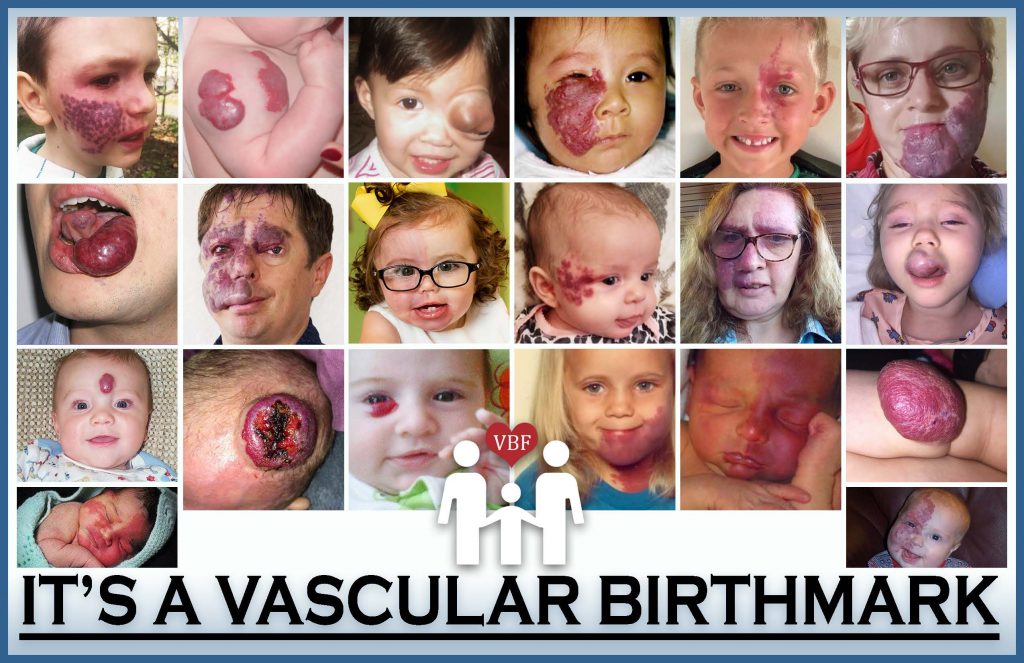 Types of Vascular Birthmarks
